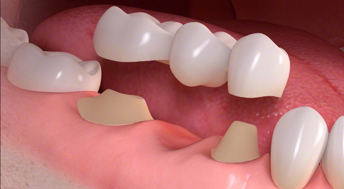 Punte Dentara