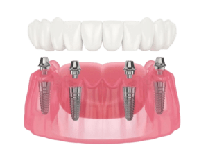Conceptul All-on-X: implanturi dentare pentru reabilitări extinse All-on-4