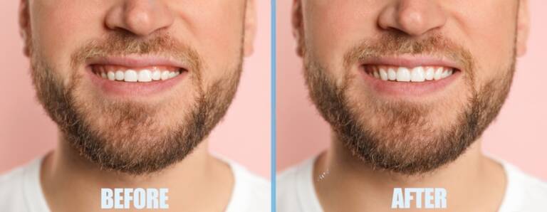 Gingivectomia